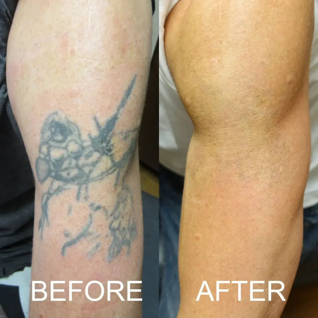 Laser Tattoo Removal: Before and After