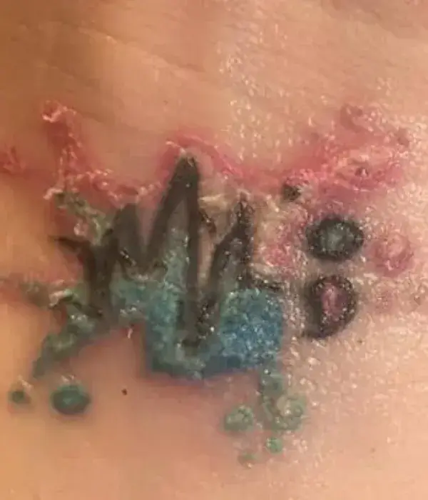 Severe Reaction: Blistering or Infection