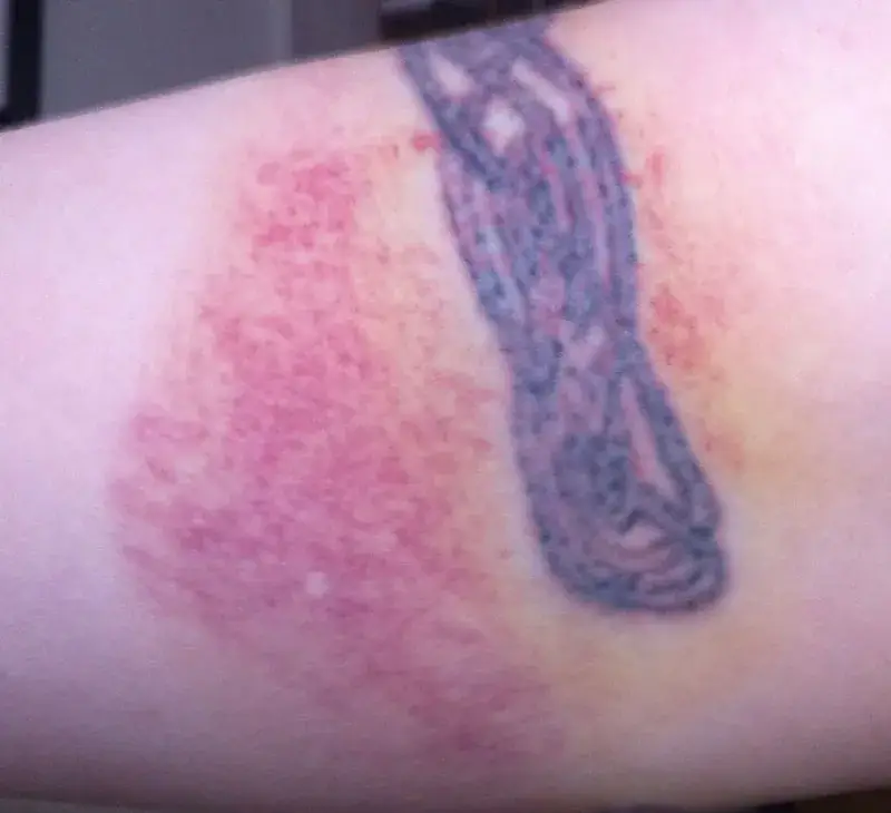 Tattoo Rash: Allergic Reaction or Irritation